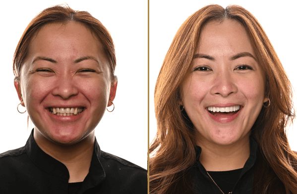 Before and after smile transformation